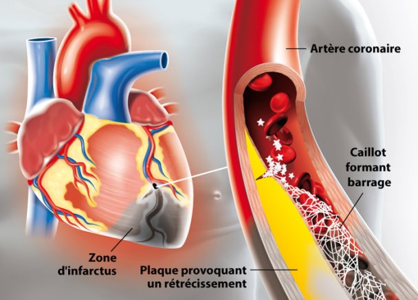 Infarctus du myocarde | Hôpital privé Dijon Bourgogne